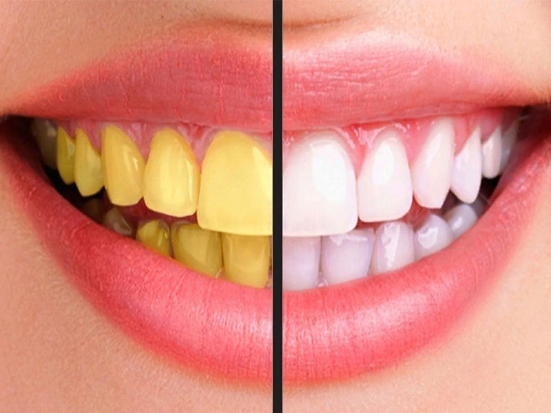 О чем говорят жёлтые зубы?