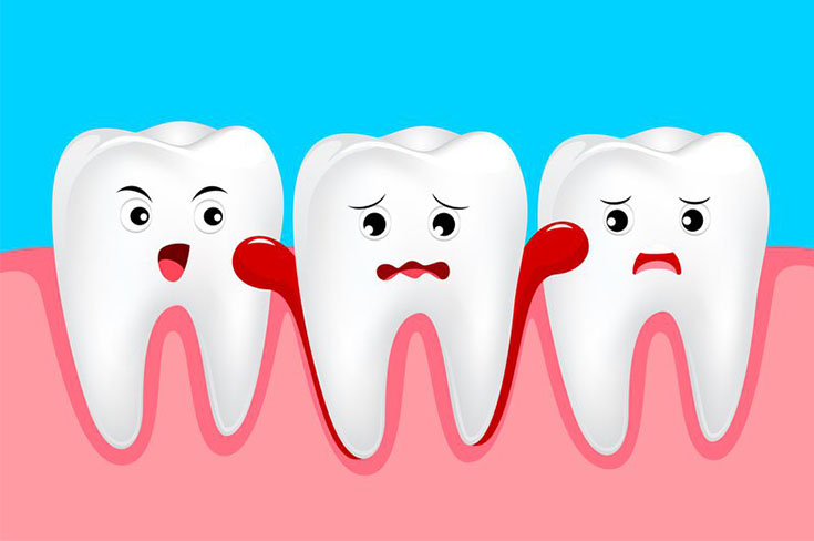 От чего может возникнуть подвижность зубов и как этого избежать?
