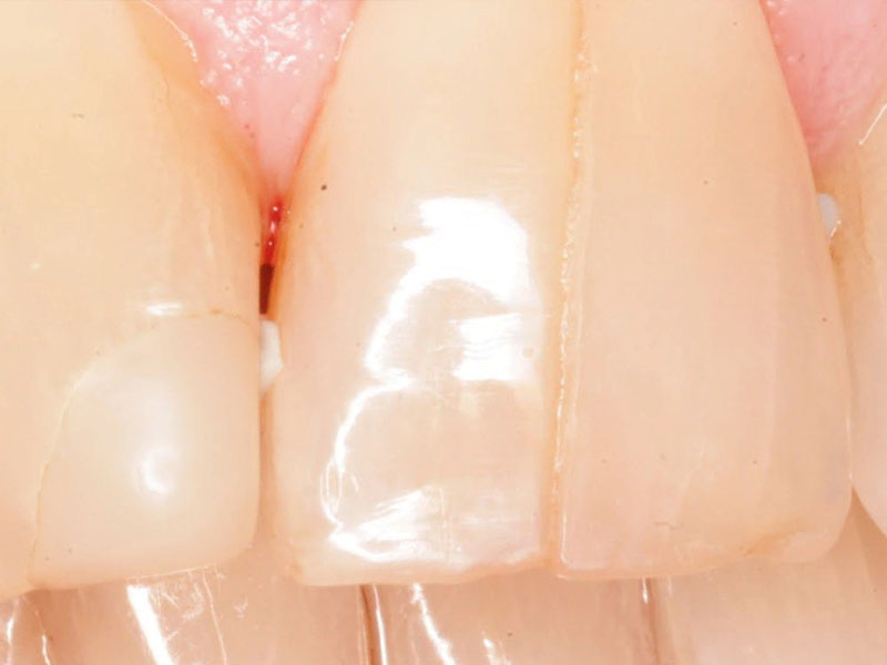 Почему возникают трещины на зубах?