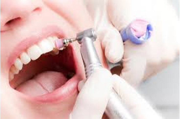 Почему рекомендуется делать профессиональную гигиену зубов до начала стоматологического лечения?