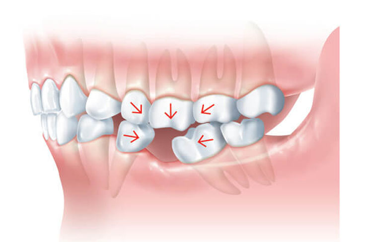 Какие последствия потери зуба?