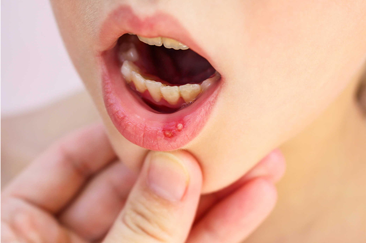 Болезненная язвочка на слизистой рта?