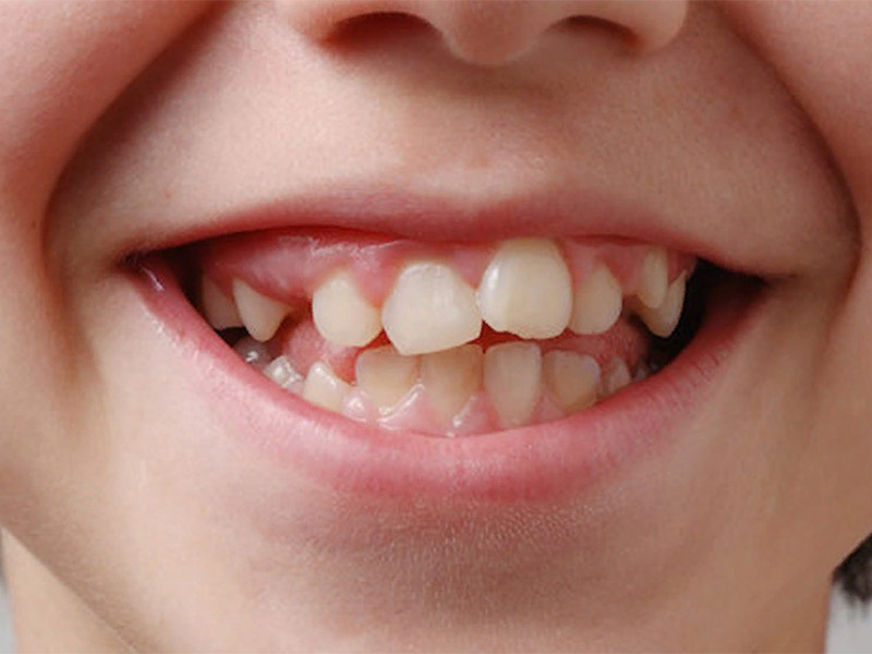 В чем причина кривизны зубов или неправильного прикуса у ребёнка?