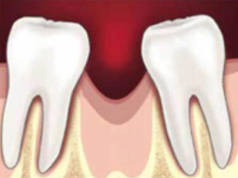 Что же будет, если удалить зуб и долгое время его не восстанавливать?
