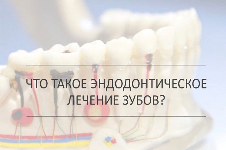 Что такое эндодонтическое лечение зубов? Болезненно ли оно?