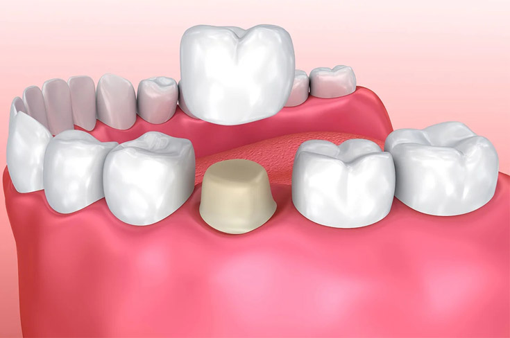 Способы восстановления депульпированного зуба!