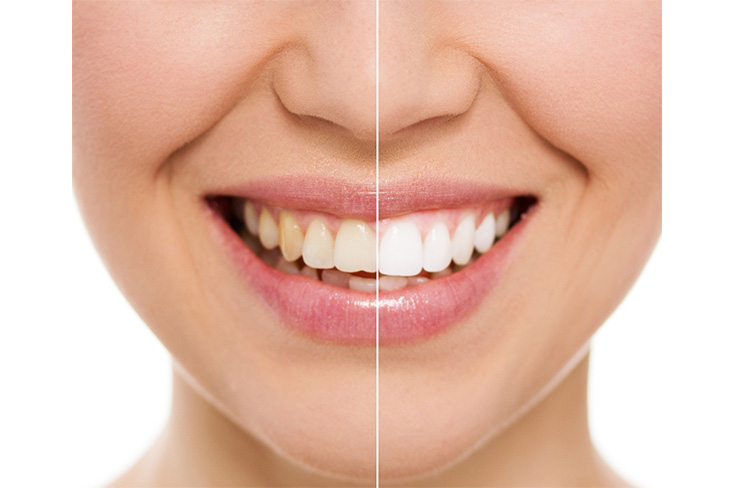 Как сохранить белизну зубов после отбеливания?