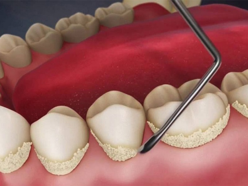 Какой вред наносит зубной камень?