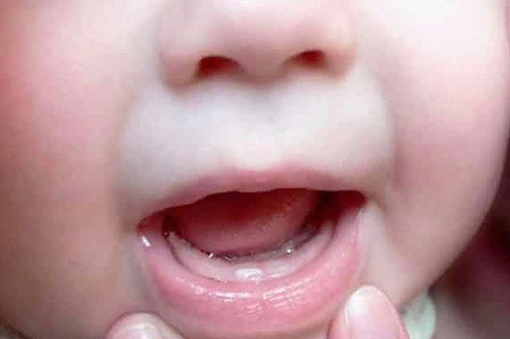 Как определить, что у ребенка уже режется первый зуб?