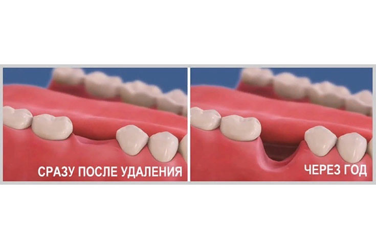 Почему важно восстанавливать зубы сразу после удаления?