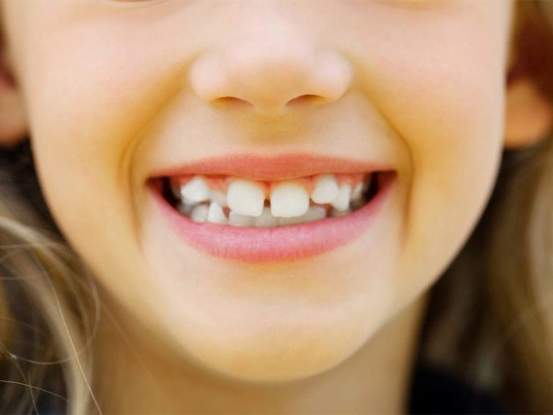 Молочные зубы у взрослых. Что делать???