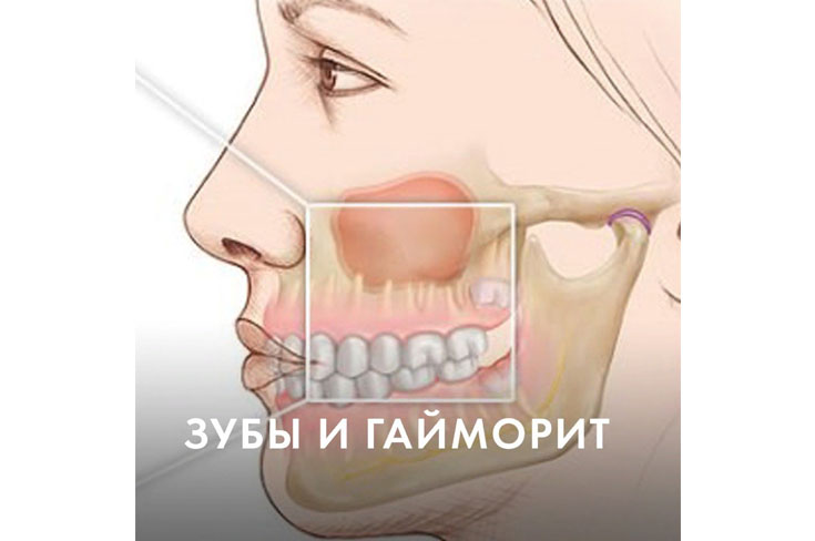 Зубы и гайморит