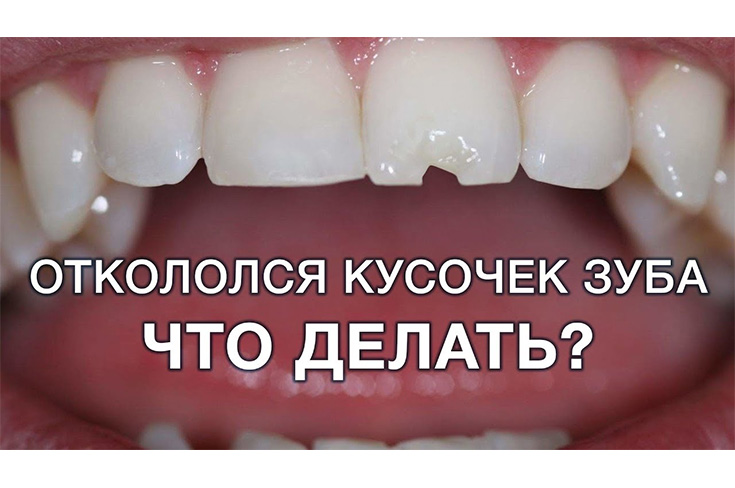 Что делать, если откололся зуб?