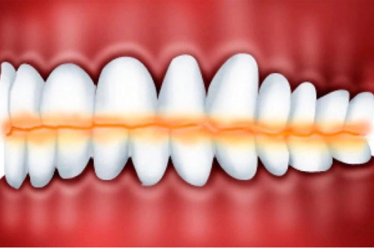 Как определить, что у вас повышенная стираемость зубов?